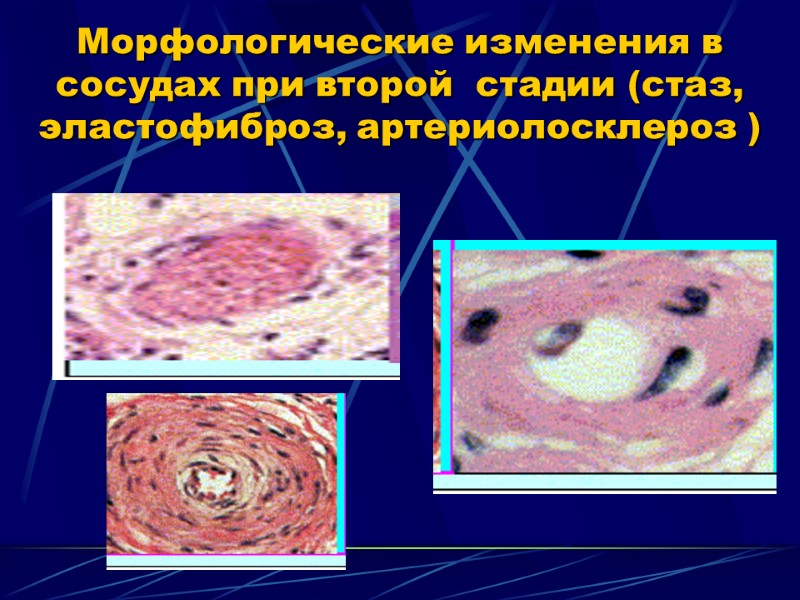 Морфологические изменения в сосудах при второй  стадии (стаз, эластофиброз, артериолосклероз )